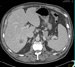 Metastatic Renal Cell Carcinoma to Liver and Peri-splenic Zone- See Arterial and Venous Phase Images - CTisus CT Scan