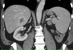 Metastatic Renal Cell Carcinoma to Liver and Peri-splenic Zone- See Arterial and Venous Phase Images - CTisus CT Scan