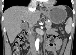 Stone in Distal Common Bile Duct (CBD) - CTisus CT Scan