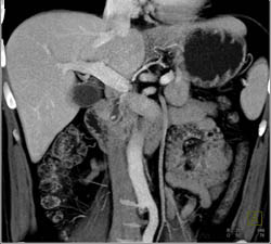 Stone in Distal Common Bile Duct (CBD) - CTisus CT Scan