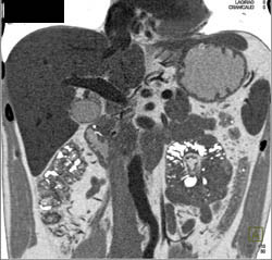 Stone in Distal Common Bile Duct (CBD) - CTisus CT Scan