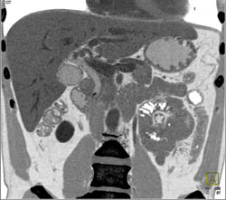 Stone in Distal Common Bile Duct (CBD) - CTisus CT Scan