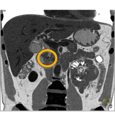 Stone in Distal Common Bile Duct (CBD) - CTisus CT Scan