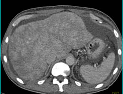 Multifocal Hepatocellular Carcinoma (Hepatoma) - CTisus CT Scan