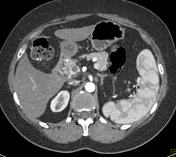 Islet Cell Tumor With Cavernous Transformation of the Portal Vein (CTPV) - CTisus CT Scan