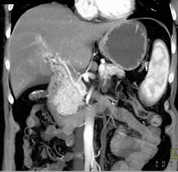 Islet Cell Tumor With Cavernous Transformation of the Portal Vein (CTPV) - CTisus CT Scan