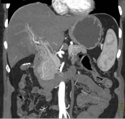 Islet Cell Tumor With Cavernous Transformation of the Portal Vein (CTPV) - CTisus CT Scan