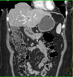 Islet Cell Tumor With Cavernous Transformation of the Portal Vein (CTPV) - CTisus CT Scan