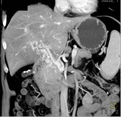 Islet Cell Tumor With Cavernous Transformation of the Portal Vein (CTPV) - CTisus CT Scan