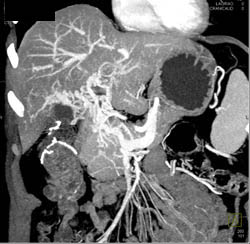 Islet Cell Tumor With Cavernous Transformation of the Portal Vein (CTPV) - CTisus CT Scan