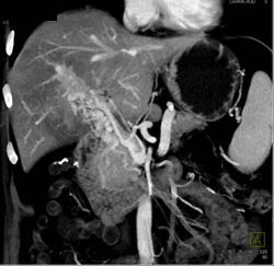 Islet Cell Tumor With Cavernous Transformation of the Portal Vein (CTPV) - CTisus CT Scan