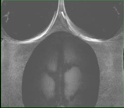 Hepatocellular Carcinoma (Hepatoma) - CTisus CT Scan