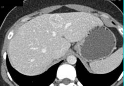 Hepatocellular Carcinoma (Hepatoma) - CTisus CT Scan