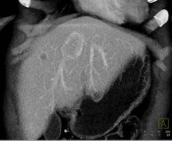 Hepatocellular Carcinoma (Hepatoma) - CTisus CT Scan