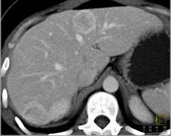 Hepatocellular Carcinoma (Hepatoma) - CTisus CT Scan