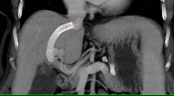 Occluded Transjugular Intrahepatic Portosystemic Shunt (TIPS) Catheter - CTisus CT Scan