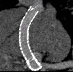 Occluded Transjugular Intrahepatic Portosystemic Shunt (TIPS) Catheter - CTisus CT Scan