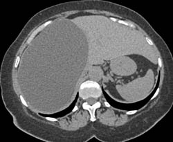 Large Liver Cyst - CTisus CT Scan