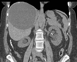 Large Liver Cyst - CTisus CT Scan