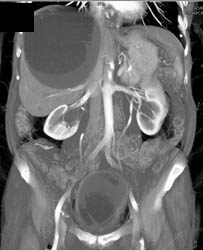 Large Liver Cyst - CTisus CT Scan