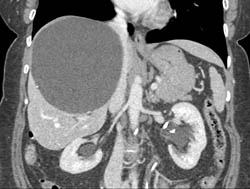 Large Liver Cyst - CTisus CT Scan