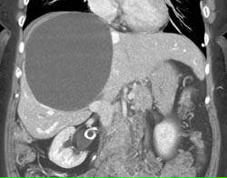 Large Liver Cyst - CTisus CT Scan