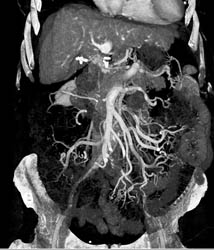 Cirrhosis With Varices Into Mesentery - CTisus CT Scan