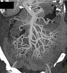 Cirrhosis With Varices Into Mesentery - CTisus CT Scan