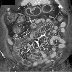 Cirrhosis With Varices Into Mesentery - CTisus CT Scan