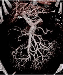 Cirrhosis With Varices Into Mesentery - CTisus CT Scan