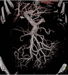 Cirrhosis With Varices Into Mesentery - CTisus CT Scan