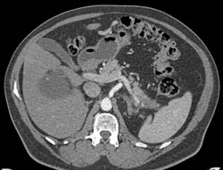 Post Radiofrequency Ablation (RFA) Changes in the Liver - CTisus CT Scan