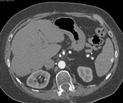 Prominent Diaphragm Folds Push Into the Liver - CTisus CT Scan