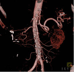 Prominent Diaphragm Folds Push Into the Liver - CTisus CT Scan