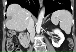 Prominent Diaphragm Folds Push Into the Liver - CTisus CT Scan