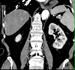 Perfusion Changes in the Liver - CTisus CT Scan