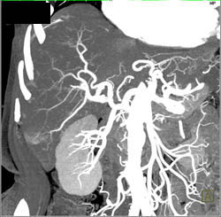 Perfusion Changes in the Liver - CTisus CT Scan