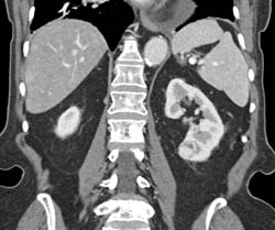 Perfusion Changes in the Liver - CTisus CT Scan