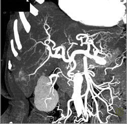 Metastatic Carcinoid to the Liver Seen Only on Arterial Images - CTisus CT Scan