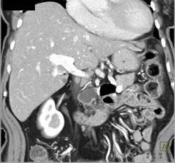 Metastatic Carcinoid to the Liver Seen Only on Arterial Images - CTisus CT Scan