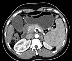 Hepatocellular Carcinoma (Hepatoma) in Cirrhotic Liver - CTisus CT Scan