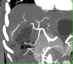 Hepatocellular Carcinoma (Hepatoma) in Cirrhotic Liver - CTisus CT Scan