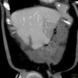 Focal Fatty Changes in the Liver - CTisus CT Scan