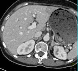 Focal Fatty Changes in the Liver - CTisus CT Scan