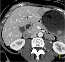 Focal Fatty Changes in the Liver - CTisus CT Scan