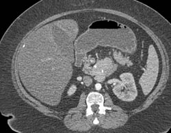 Islet Cell Tumor With Liver Metastases - CTisus CT Scan