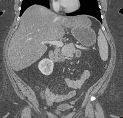 Islet Cell Tumor With Liver Metastases - CTisus CT Scan