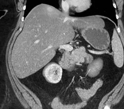 Islet Cell Tumor With Liver Metastases - CTisus CT Scan