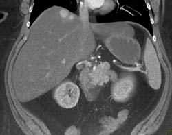 Islet Cell Tumor With Liver Metastases - CTisus CT Scan