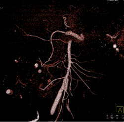 Hepatocellular Carcinoma (Hepatoma) With CTA - CTisus CT Scan